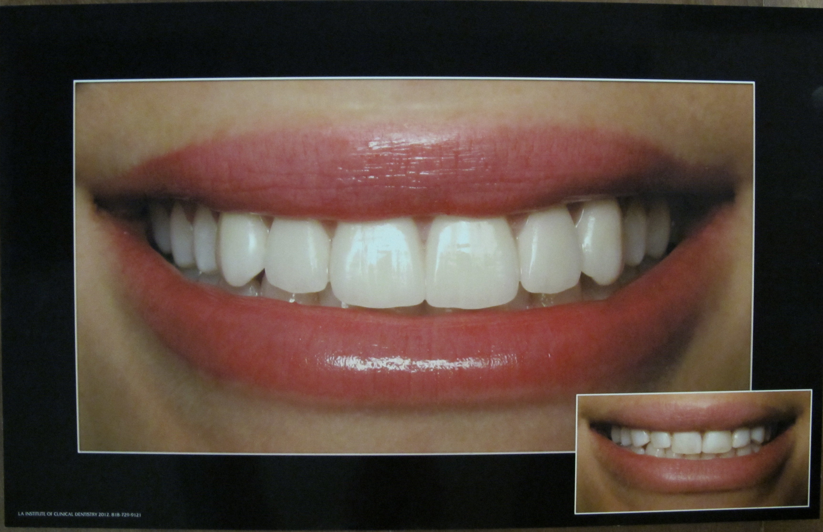 beautiful-smile-before-and-after-los-angeles-institute-of-clinical