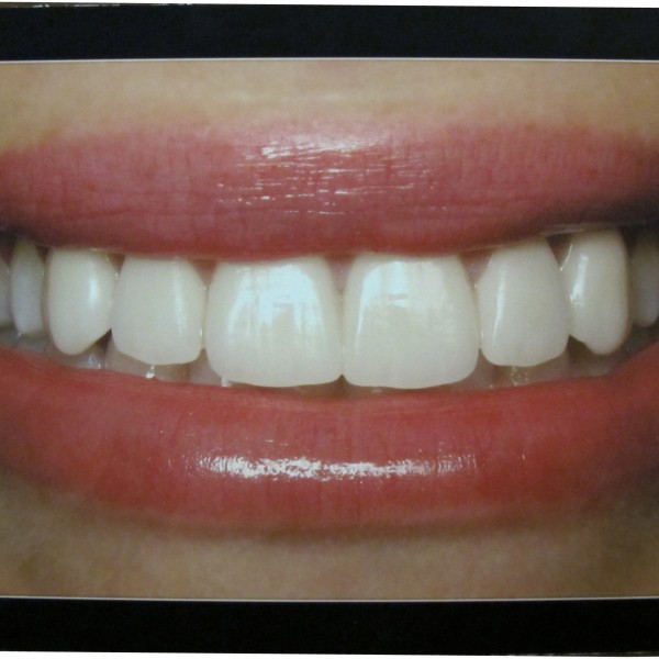 Ideal Smile Poster | Los Angeles Institute of Clinical Dentistry & Ruiz ...