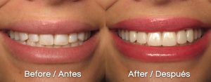 RDS-before_after_teeth_espanol