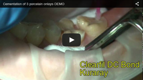 cementation-of-3-porcelain-onlays-DEMO