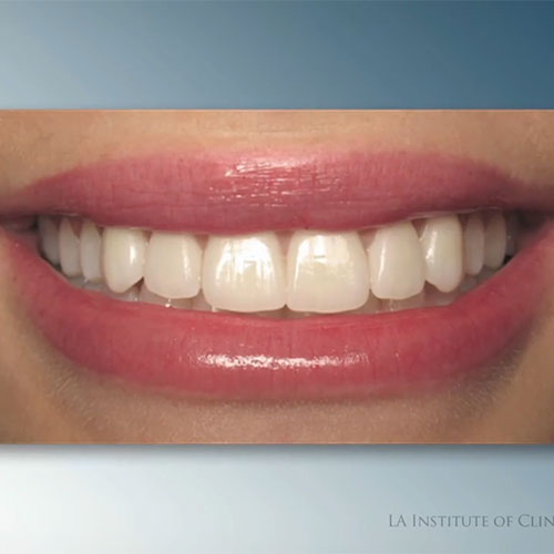 Ideal Smile Poster | Los Angeles Institute of Clinical Dentistry & Ruiz ...