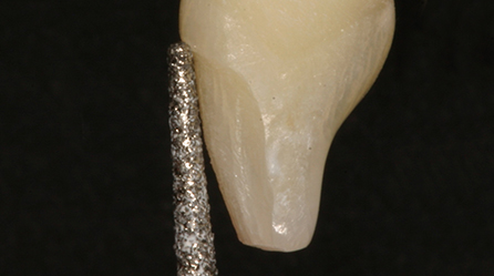 Veneers Image