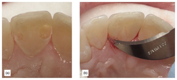 Figure 10: (a) Enamel preservation in a direct clinical case. (b) Supragingival margins allow for a much easier cleanup of composite flash and finishing.