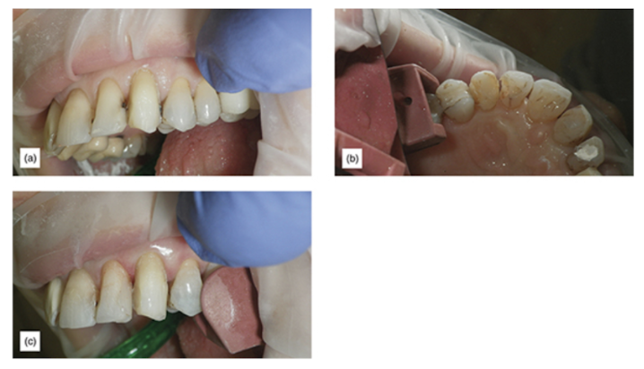 Figure 11: (a) Caries which appear to go deeply subgingival, after initial veneer preparation. (b) Lingual view of extreme caries and removal using enamel preservation technique preparation. (c) Finishing preparation, after repair with composite; the tooth looks natural.