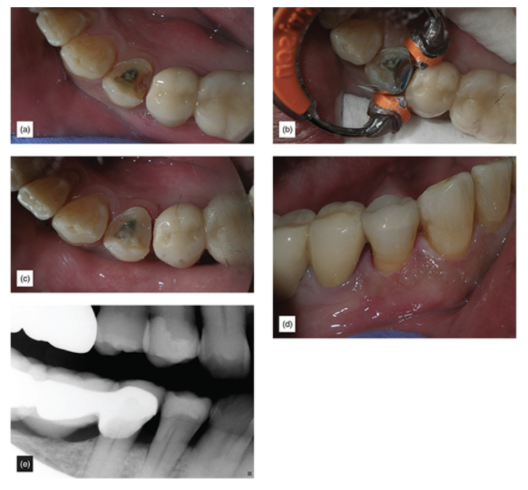 Figure 13: (a) Extremely subgingival margin. (b) Correctly isolated using the matrix band. (c) After margin elevation. (d) The finished restoration. (e) Final x-ray.