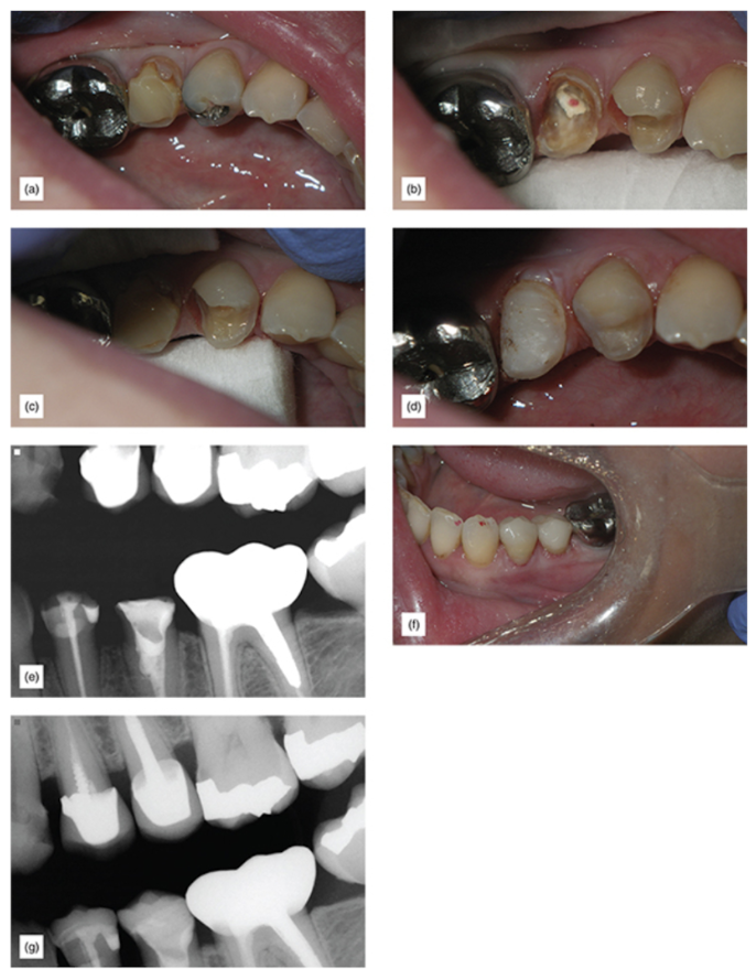 Figure 14: (a) This patient was informed of the poor prognosis of the second bicuspid. (b) Observe the extent of the damage to both teeth. (c) A different view to show how subgingival the margins are, and how difficult this would be if indirect bonded restorations were attempted with gingiva this deep. (d) After margin elevation. (e) X-ray confirming good margin elevation seal. (f) Immediately after cementation. (g) Two years postoperative x-ray. After the margin elevation, an impression will be taken and the tooth can be provisionalized. The bonded cementation will be easy and stress free, as all margins will be supragingival.