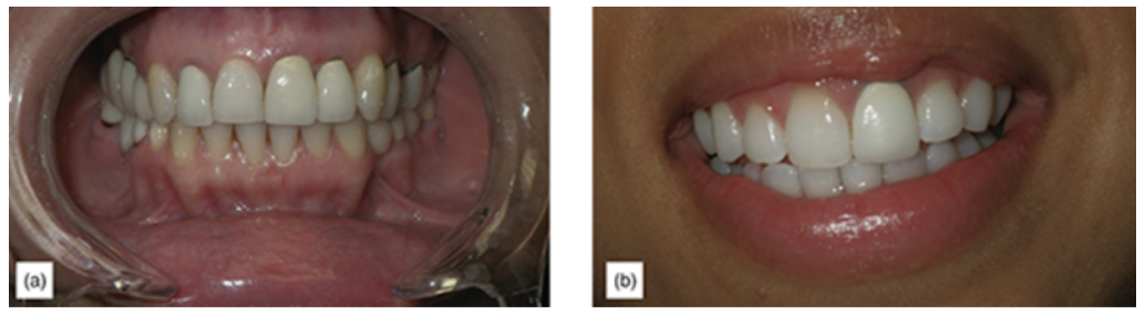 Figure 15: (a) Anterior crown with subgingival margins. (b) Extremely non-esthetic, opacious porcelain-fused-to-metal crown.