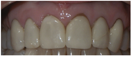 Figure 16: Opacious-looking restorations.