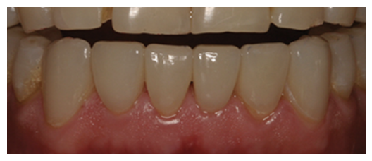 Figure 17: Almost 1 mm supragingival margins on six lower anterior veneers, 1 year postoperatively.