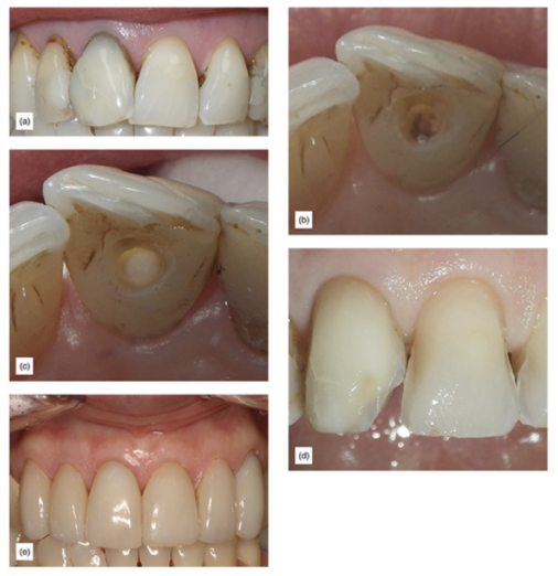 Figure 18: (a) Dark tooth before internal bleaching. (b) Open endodontic access and removal of pulp and cement debris. (c) Lingual view after one cycle of internal bleaching. (d) Veneer preparation procedure showing how much more simple this case is now. (e) The final restoration.