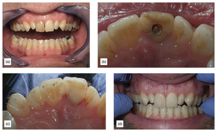 Figure 19: (a) Extremely dark central. (b) Lingual view before internal bleaching. (c) Internal view after bleaching and endodontic access filled. (d) Final veneer cemented with supragingival margins. 