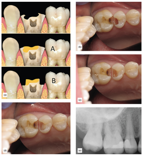 Figure 9: Outcome comparison: (a) A badly damaged tooth with unsupported enamel after a supragingival approach (A) or with traditional crown preparation approach (B). (b) Deep caries on bicuspid; enamel is healthy but there are much deeper caries on the dentin. (c) Dentin caries continues while healthy enamel is preserved supragingivally. (d) All caries have been removed, and an indirect pulp cap has been placed. (e) Final x-ray showing discrepancy between supragingival enamel level and dentin level; supragingival