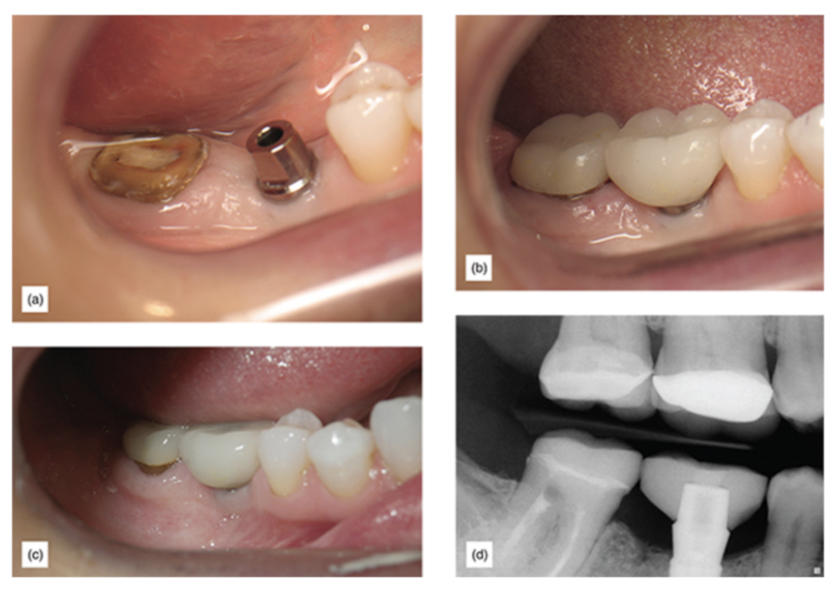 Figure 3: (a) Second molar, which had a fractured crown at gum level. (b) Crown with zero mechanical retention cemented. (c) The same crown 6 years postoperatively. (d) X-ray of the crown 6 years postoperatively.