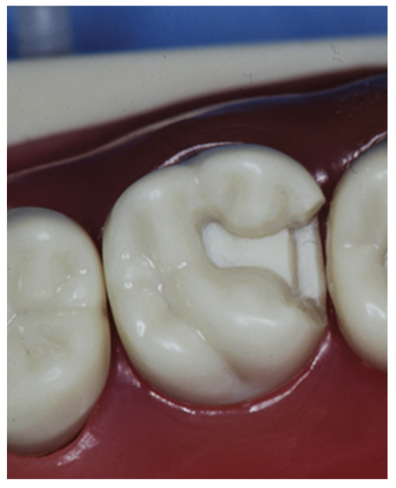 Figure 4: Traditional onlay preparation showing aggressive mechanical retention features (courtesy of Dr Boris Keselbrener).