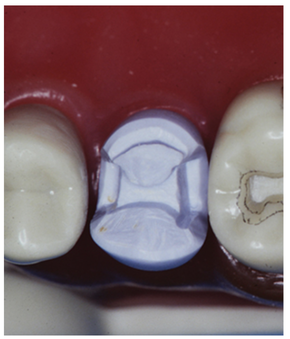 Figure 5: Boxes with subgingival margins on x-ray.