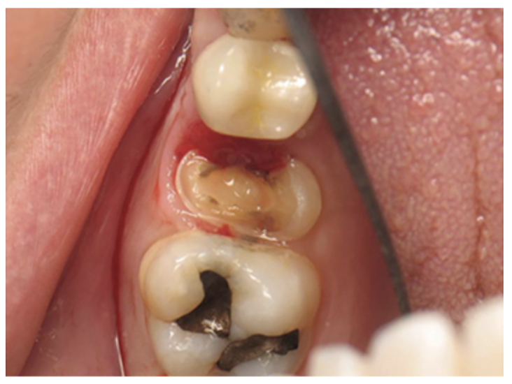 Figure 6: Box with bleeding subgingival margin.