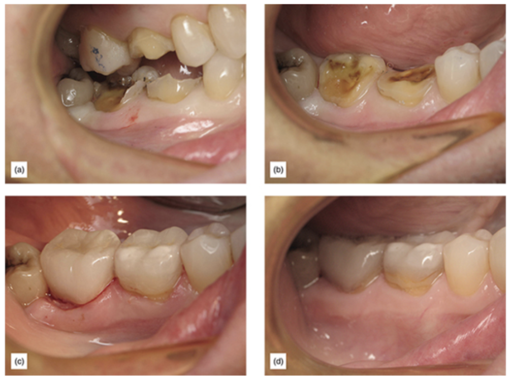 Figure 7: (a) Teeth of a frail patient who was previously treated for root canal/post/crown plus crown lengthening surgery. (b) After a minor preparation, preserving as much tooth as possible and enamel margin. (c) Immediately after cementation. (d) One year postoperatively.