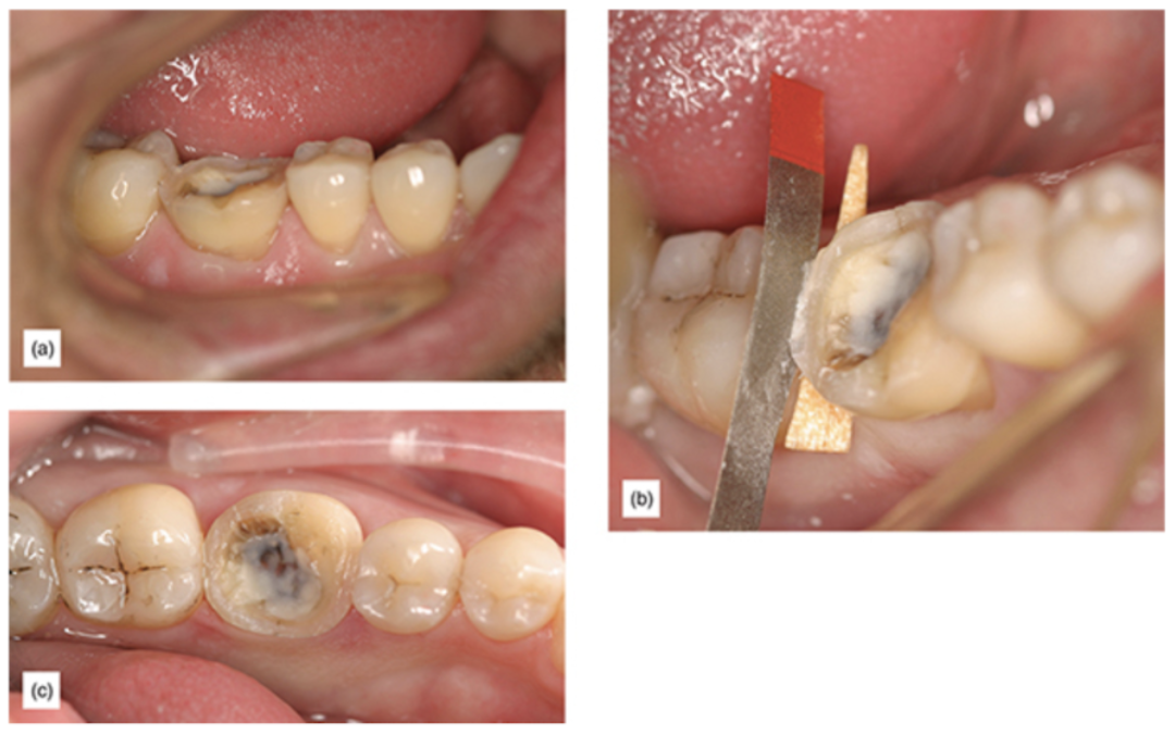 Figure 8: (a) After the occlusal reduction, the cavosurface margin continues to be in contact with the adjacent tooth. (b) Clearance created with the cervical margin separation technique. This allows restoration margins to remain supragingival. (c) The final preparation with clear proximal margins.