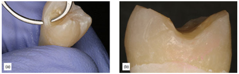 Figure 12: (a) Tooth prepared for enamel preservation study (1 mm thick enamel). (b) A close-up of non-stained margin on enamel preservation study.