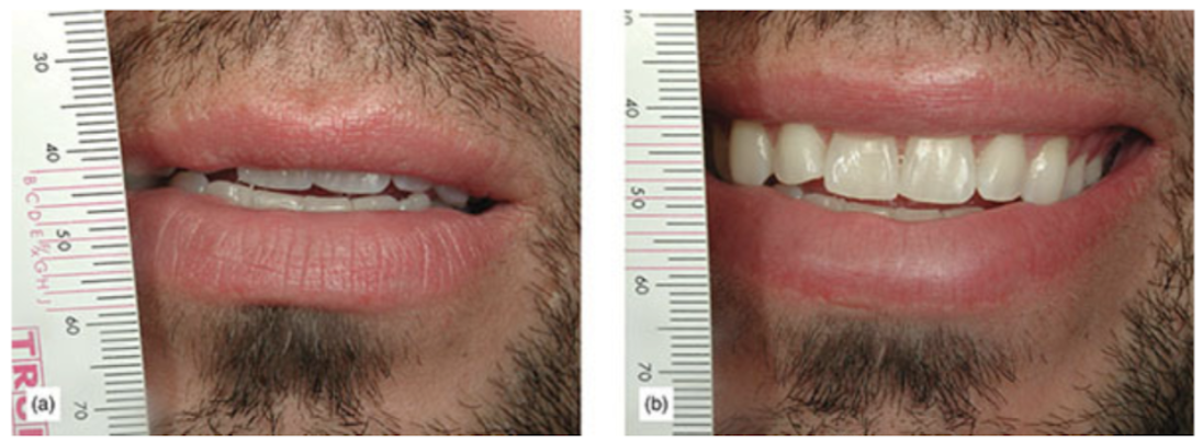 (a) Male repeating the number “66,” a conversational tooth view. (b) Same male smiling.