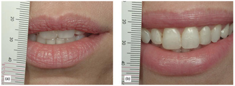 (b) Compare the amount of tooth shown when smiling