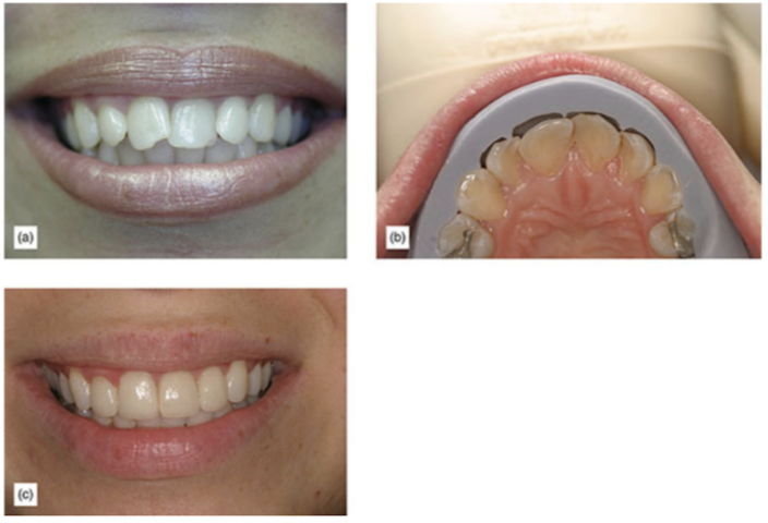 (a) Female patient with rotation and axial inclination problems who was unwilling to undergo orthodontics. (b) Using the silicon matrix to ensure separation in the correct area, to achieve correct tooth size. (c) Final result with four veneers.