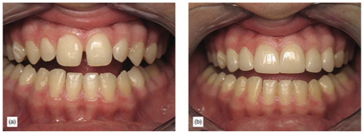 (a) Spacing was deemed to be possible without orthodontics. (b) Good results achieved with veneers only.