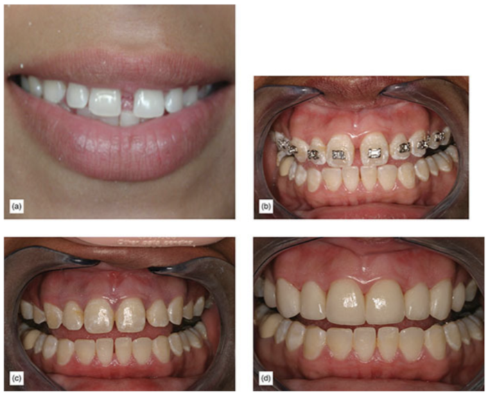 (a) Some cases should be treated with preprosthetic orthodontics to avoid ending up with asymmetries or excessively large centrals. (b) Preprosthetic orthodontics to improve spacing. (c) After bracket removal. (d) Postoperative view.