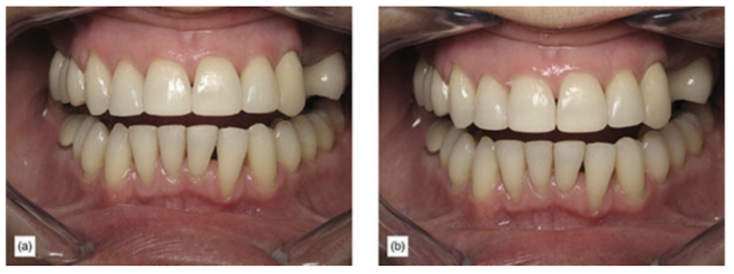 (a) Uneven incisal embrasures can create an undesirable esthetic appearance. (b) Minor enamel recontouring of the incisal edges and embrasures can have a very positive esthetic improvement.