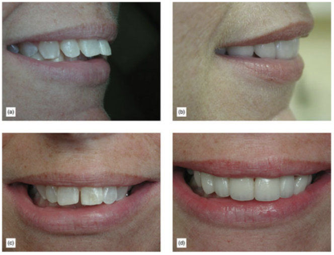 Older case of female not wanting wires and brackets orthodontics to front view of finish veneers