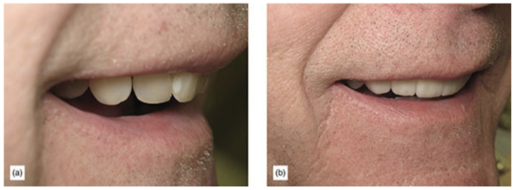 (a) Excessive retroclination of anterior teeth. (b) Improved retroclination and effect on lips.