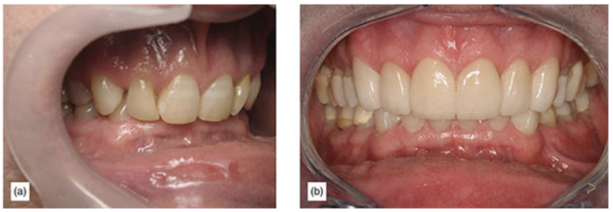 (a) 110% overbite and patient biting his palate. (b) After bite opening with bonded veneers and long-term onlay temporaries.