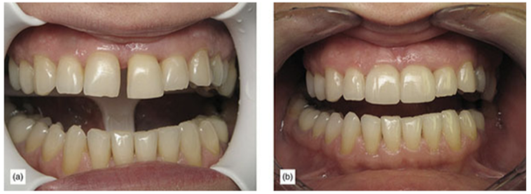 Open gingival embrasures and large diastemas can be very challenging.