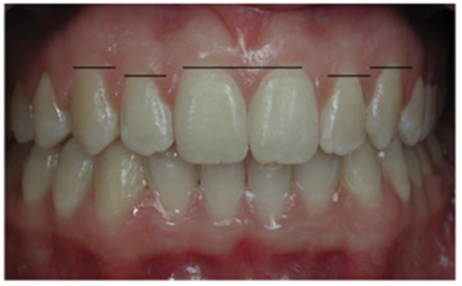 Gingival zenith of teeth has a great influence in esthetics.