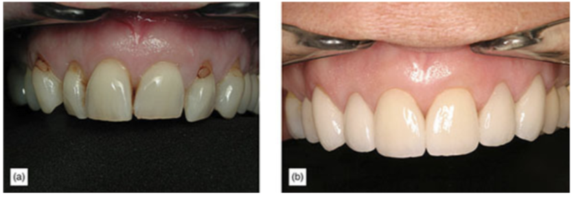 (a) Teeth dark and stained. (b) After bleaching and veneers.