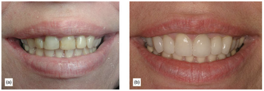 (a) The ratio of the teeth makes them look square and anesthetic. (b) After some crown lengthening and veneers.