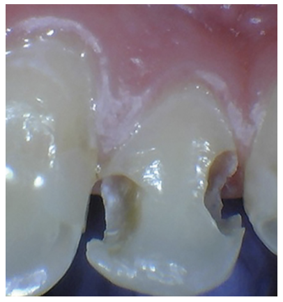 Figure 1: Class III preparation showing an internal outline larger than the external outline.