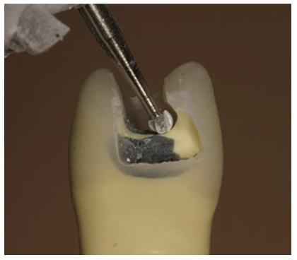 Figure 2: Thanks to the reinforcement effect of adhesion, cusps with an undercut and some unsupported enamel can be restored to close to their original strength.