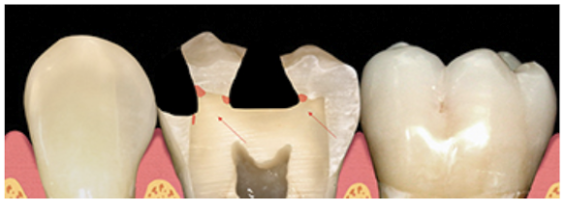 Figure 4: Areas where caries stain can uncover hidden caries.