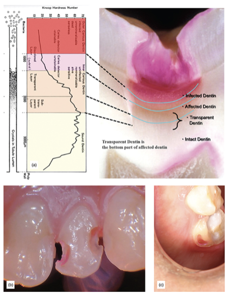 Figure 5: (a) Caries layers showing how they stain with red caries detector (courtesy of Dr. Shigehisa Inokoshi). (b) Dentin stained red is carious and must be removed, pink staining shows non-infected tooth, which should be left, anterior. (c) Caries indicator used to uncover caries on a posterior tooth.