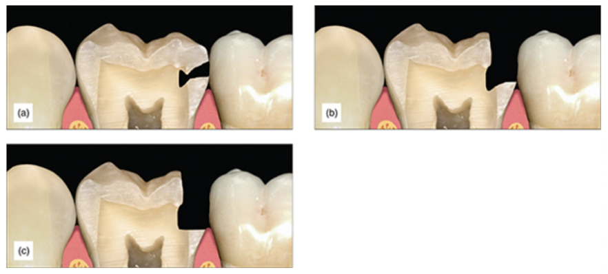 Figure 6: (a) Interproximal caries. (b) After caries removal, the margin is in contact and supragingival. (c) After traditional cervical contact breaking, the margin ends subgingivally.