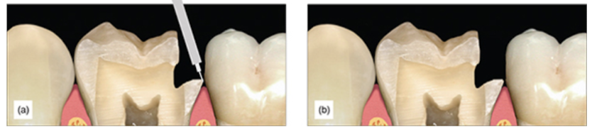 Figure 7: (a,b) The finished preparation with minor beveling.