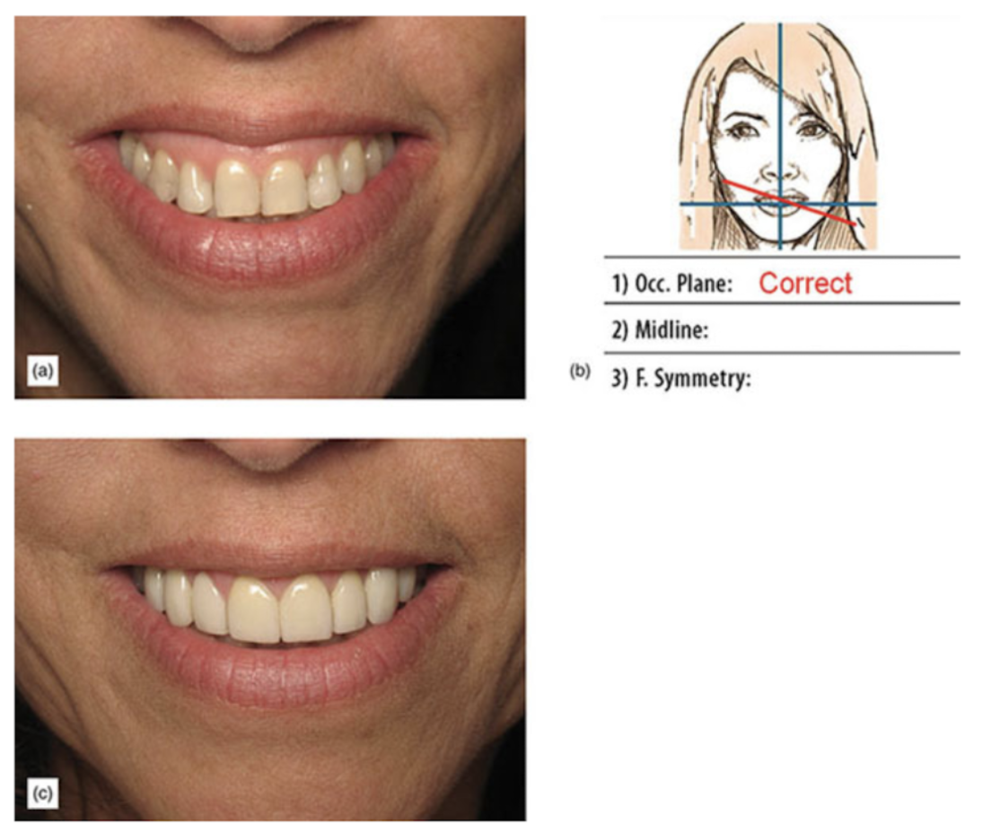 Occlusal Plane, Front Full-Face Smiling