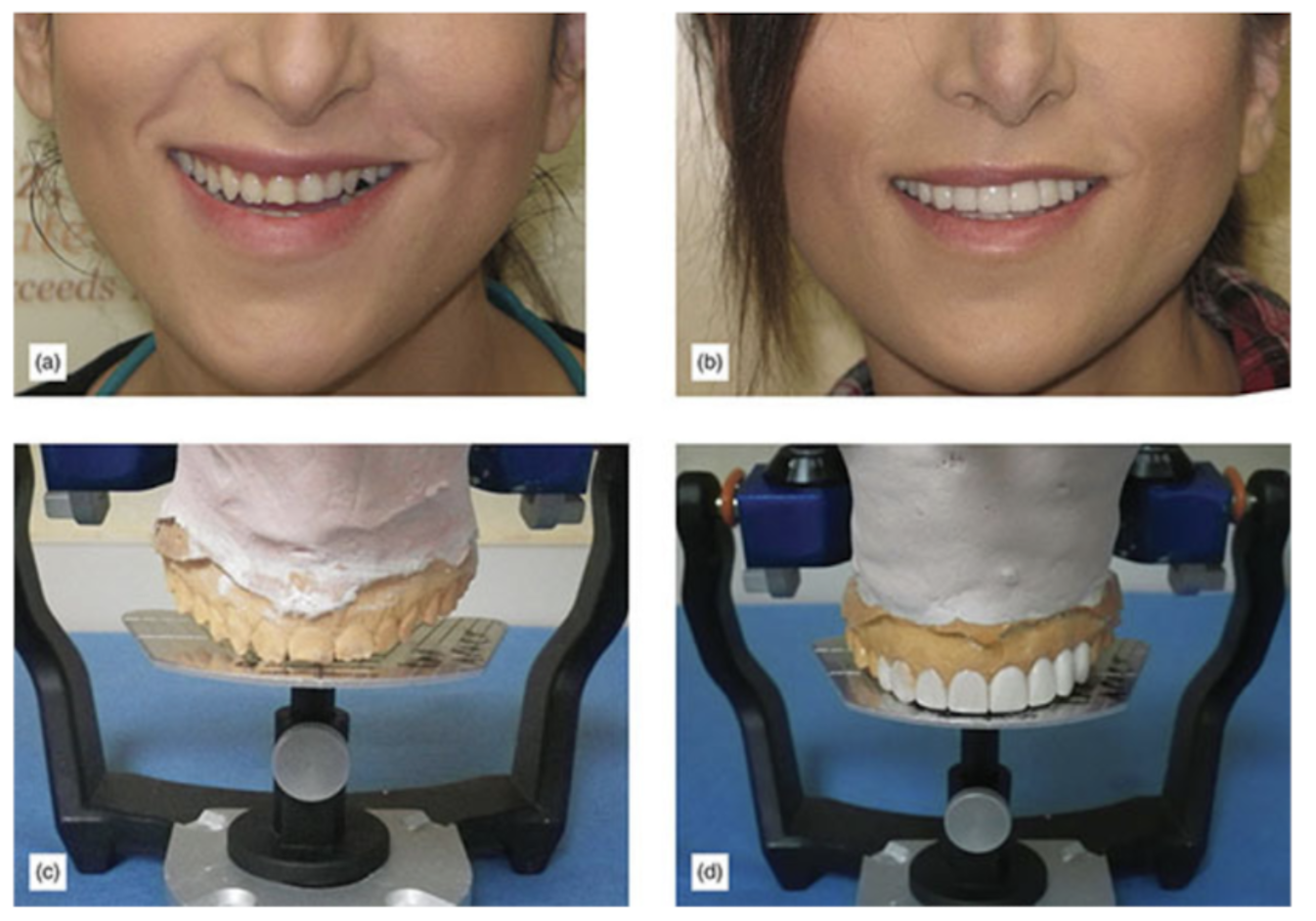 Facial Symmetry (Front Full-Face Smiling)