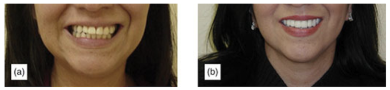 Buccal Corridor (Front Smile View)