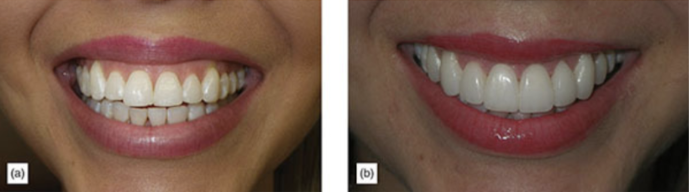 Gingival Show (Front Smile View)