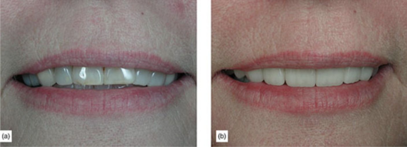 Incisal Plane (Front Smile View)