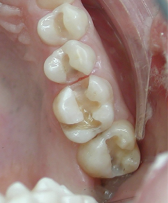 Geometric amalgam preparation.