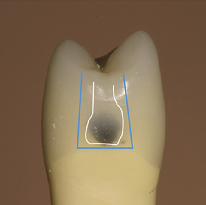 Outline of a traditional geometric preparation vs a bonded composite preparation’s more tooth-preserving outline.