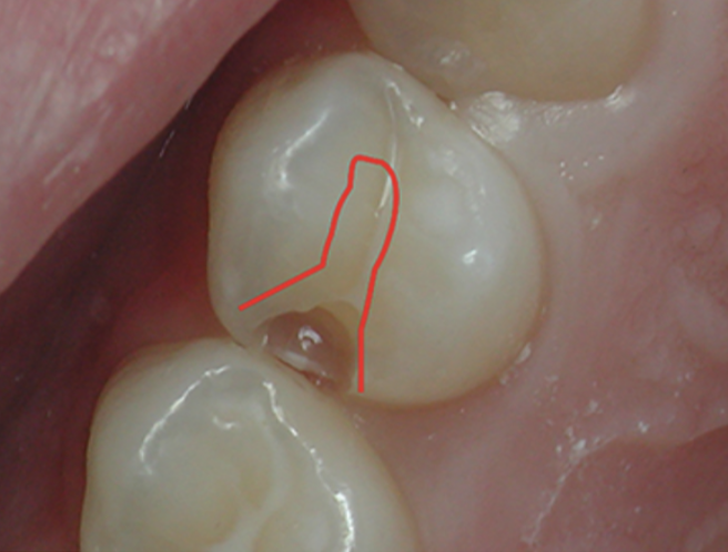 Comparison of a tooth-conserving composite preparation with a traditional occlusal outline for amalgam preparation.